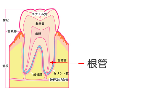 根管治療
