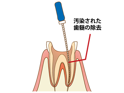 歯髄組織を取り除く