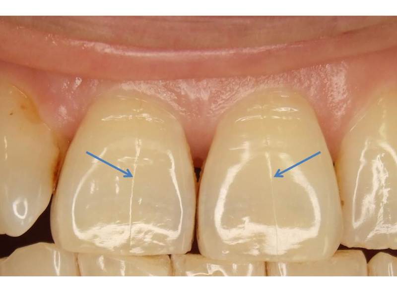 歯のマイクロクラック① - 神田の歯医者｜神田デンタルケアクリニック