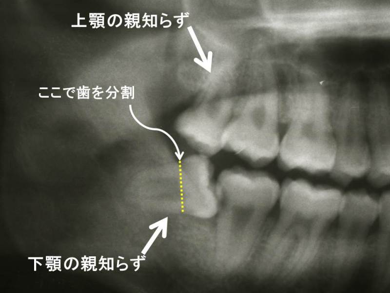 腫れ 親知らず 親知らず抜歯後、腫れない人・腫れる人の違い [歯・口の病気]