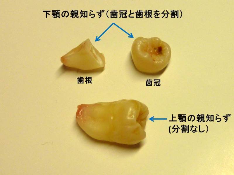 抜く 親知らず 親知らずを抜くメリットとデメリットについて