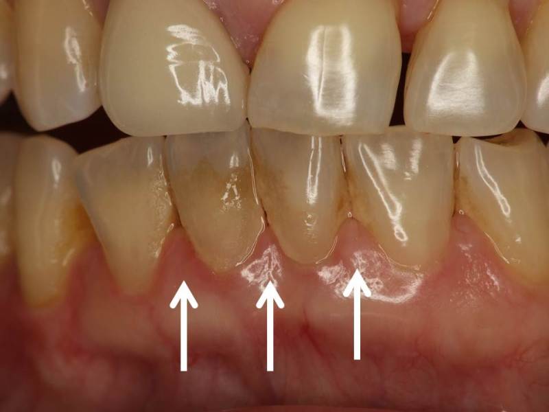 下顎前歯は歯石が付きやすい プラーク 歯垢 と歯石による歯茎の腫れ 神田の歯医者 神田デンタルケアクリニック