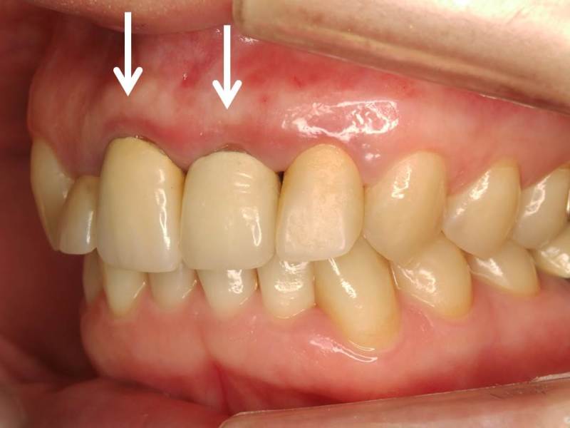 歯茎 歯肉 の腫れの原因 クラウンの不適合 神田の歯医者 神田デンタルケアクリニック