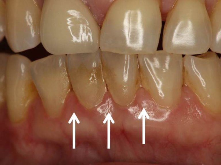 歯石は歯にどのように見えますか?