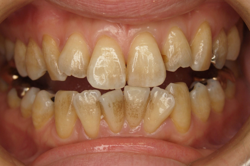 歯のホワイトニング: それは神話ですか、それとも真実ですか?疑問を解消しましょう！