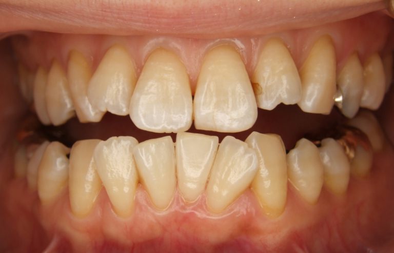 歯のホワイトニング: それは神話ですか、それとも真実ですか?疑問を解消しましょう！