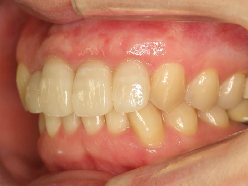 自然 歯茎 治る 腫れ に 歯茎の膿を放置していていいのでしょうか