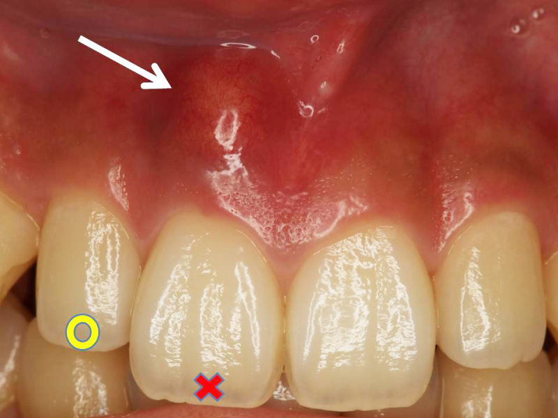 生理 歯茎 の 腫れ