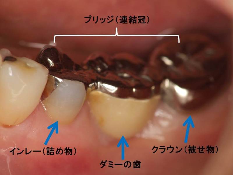 インレー・ブリッジのメリットとデメリットについて - 神田の歯医者 