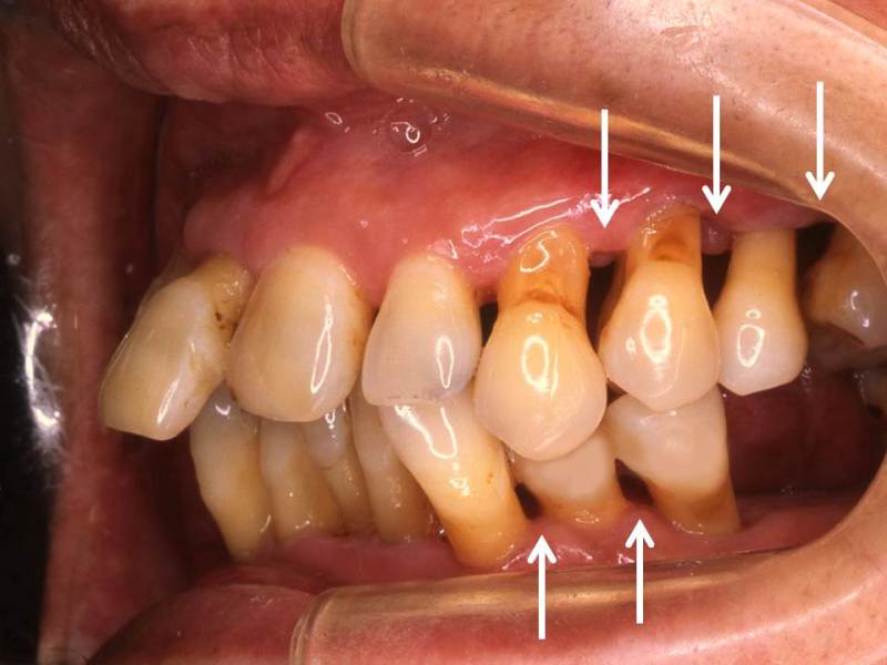 歯周病手術（ＦＯＰ；フラップ・オペレーション）後の歯肉退縮（歯茎が下がる）は避けられない - 神田の歯医者｜神田デンタルケアクリニック