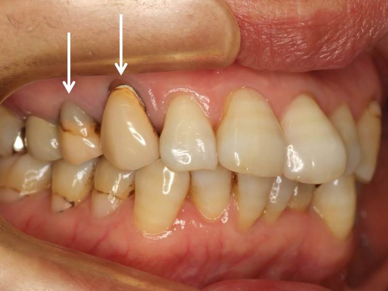 差し歯の付け根 縁 の黒ずみ ブラック マージン をセラミック クラウンできれいに1 神田の歯医者 神田デンタルケアクリニック