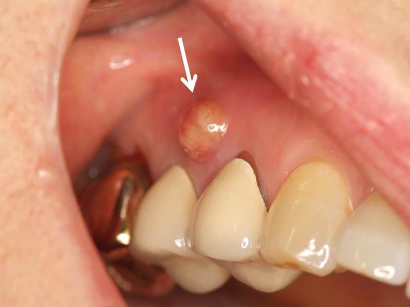 腫れ 歯茎 の 歯茎の腫れ、ぶよぶよしている状態を放置すると危険！【医師監修】