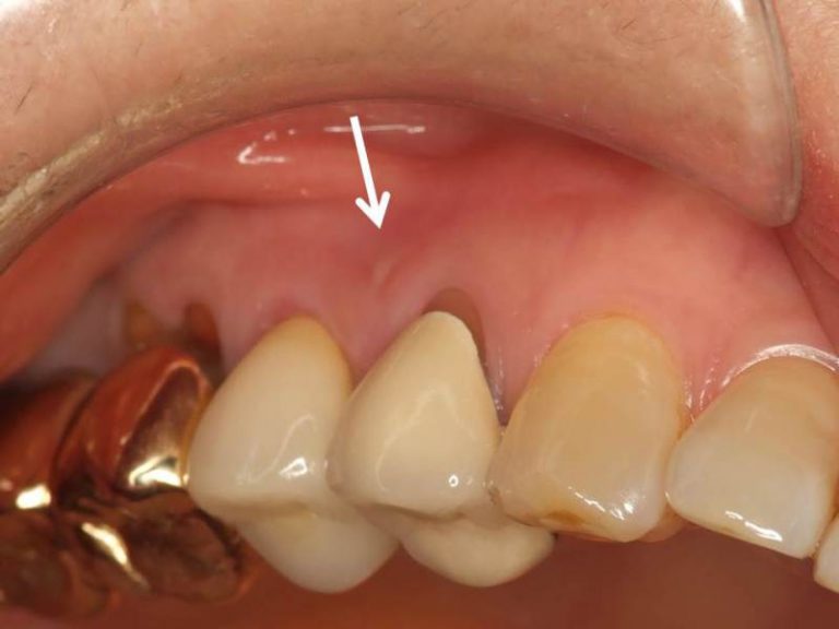 歯茎 の 腫れ 放置