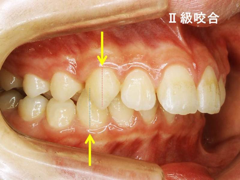 簡易的な不正咬合の見分け方 噛み合わせは 犬歯の位置関係が重要 2 神田の歯医者 神田デンタルケアクリニック 簡易的な不正咬合の見分け方 噛み合わせは 犬歯の位置関係が重要 2 神田の歯医者 神田デンタルケアクリニック
