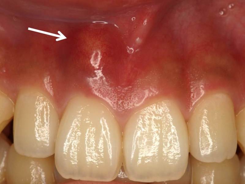 歯髄壊死による歯茎の腫れは、早めの根管治療が必要！1 神田の歯医者｜神田デンタルケアクリニック
