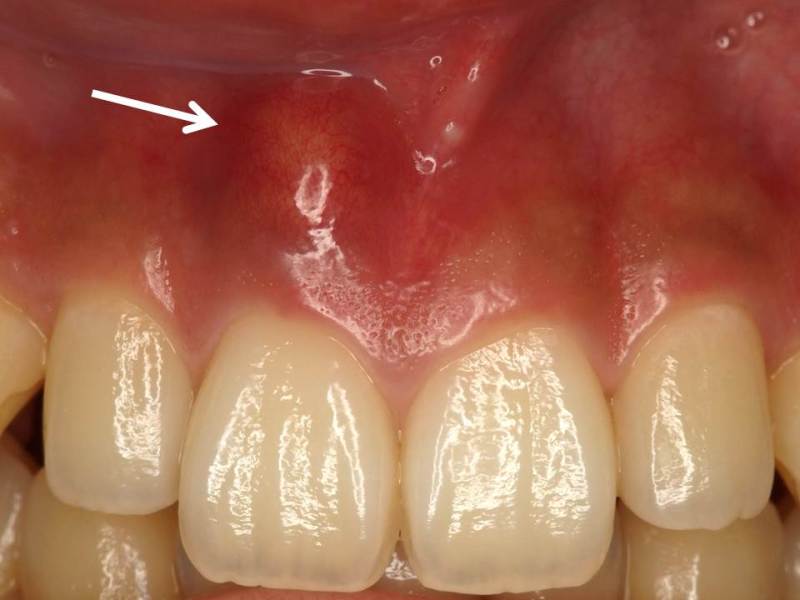 歯茎 の 白い 腫れ