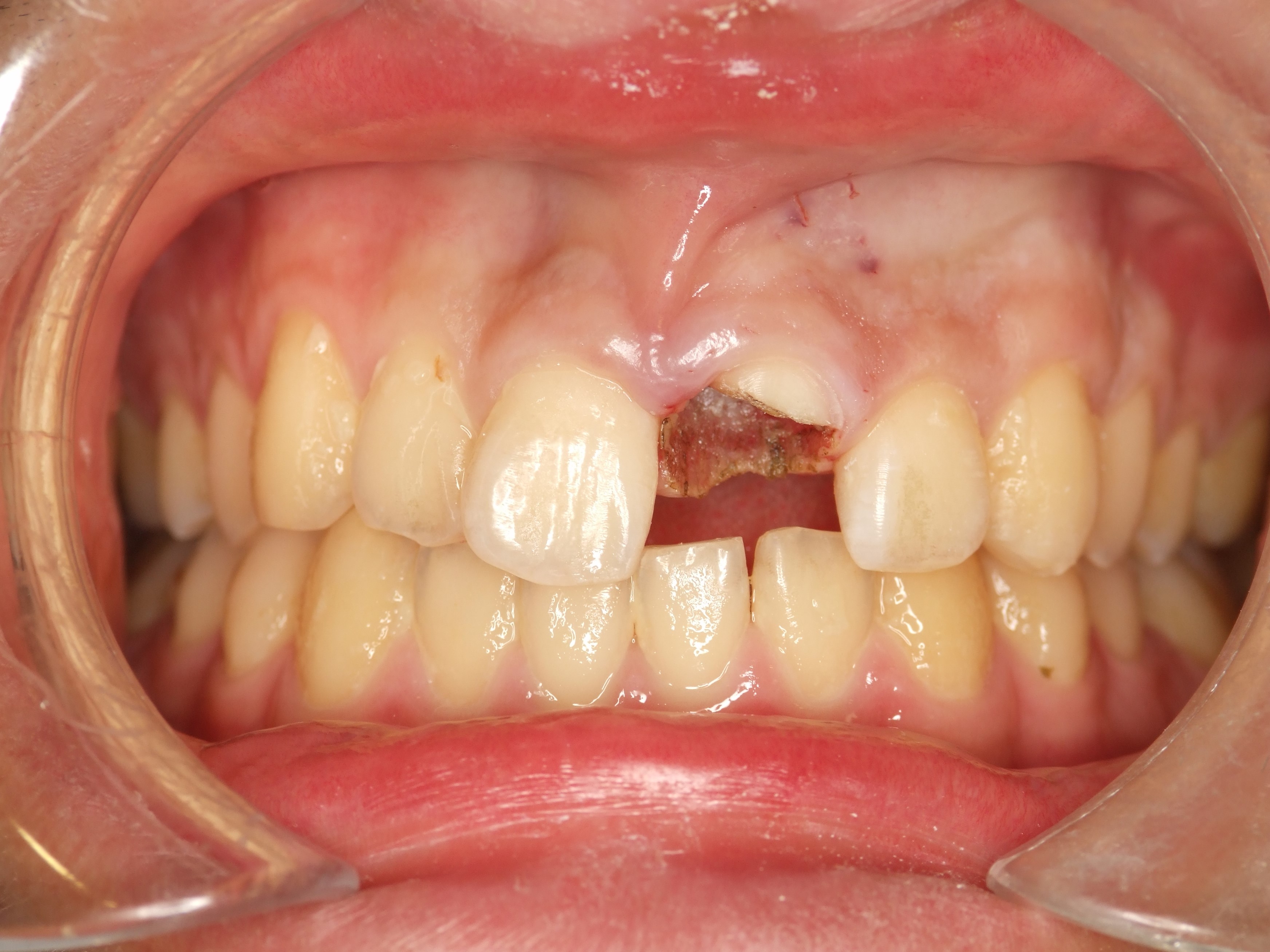 歯 が 根元 から 折れ た