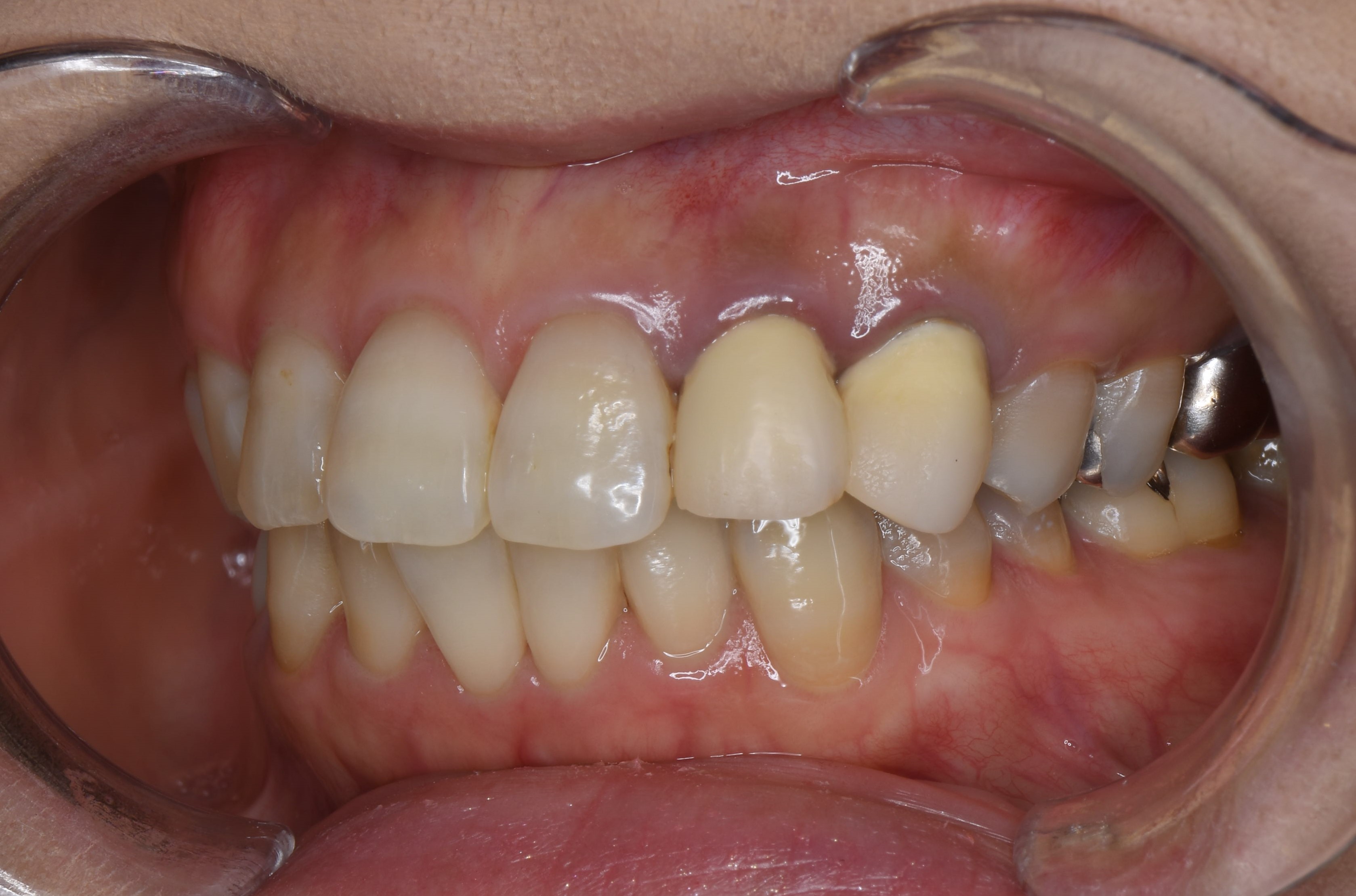 保険の不適合な差し歯は 歯茎の炎症と変色を惹起する 神田の歯医者 神田デンタルケアクリニック