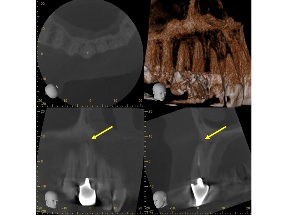 鼻の横を押すと痛む原因はこれだ 犬歯の根尖病巣 神田の歯医者 神田デンタルケアクリニック