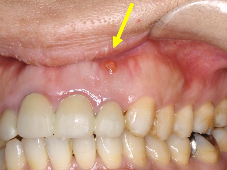 根尖病巣による歯茎の腫れと、不適合なセラミッククラウンによる歯茎の 