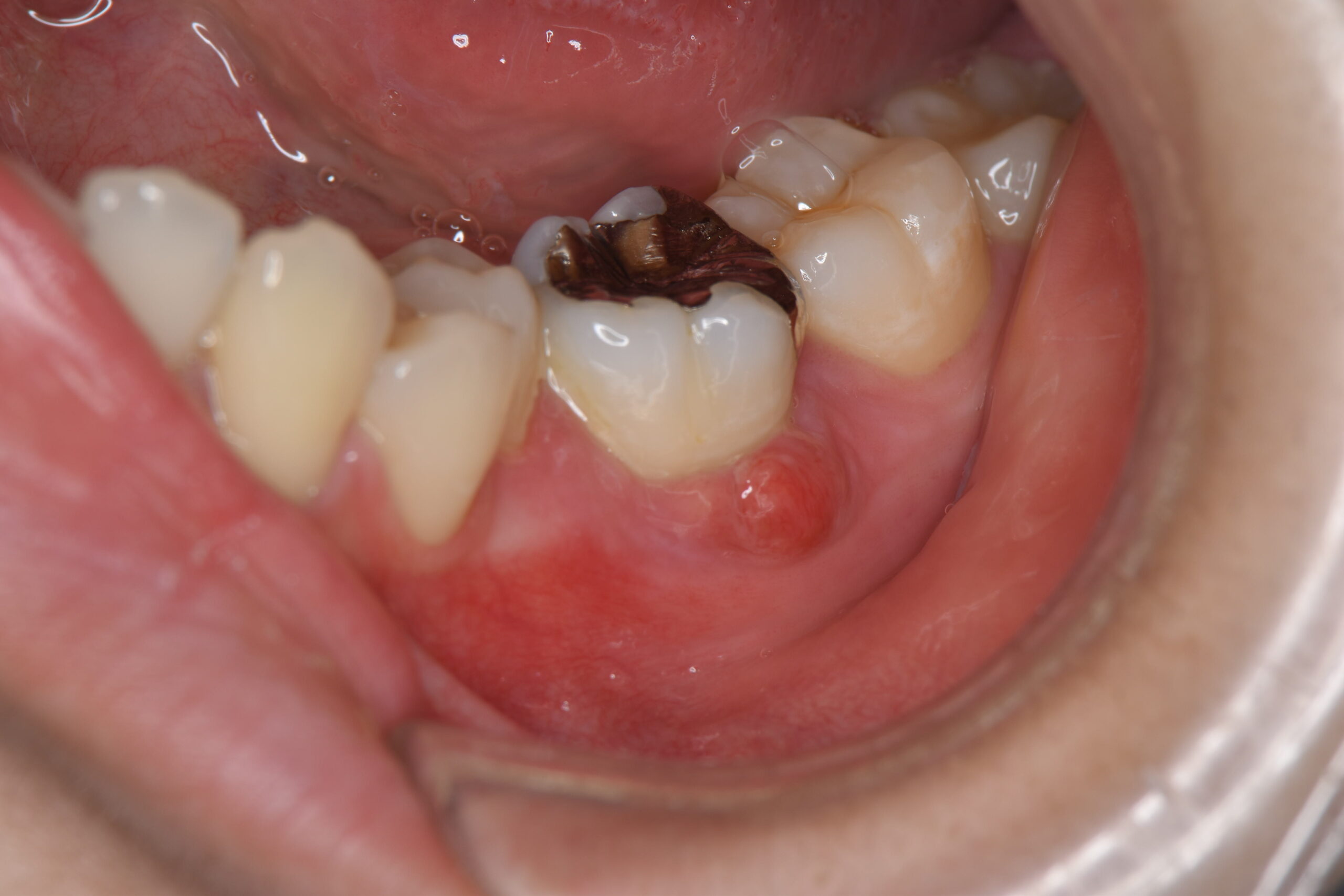 歯茎 が ぷくっ と 腫れる